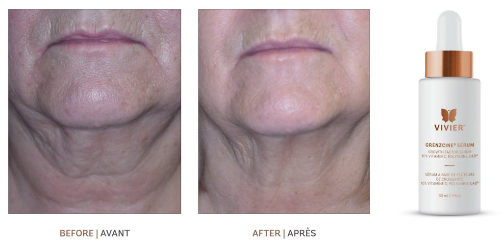 Vivier GrenzCine Serum – Dermatologie Shop